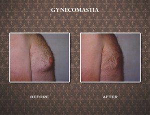 What is Gynecomastia?