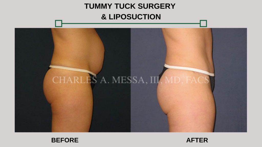 Tummy Tuck Surgery & Liposuction-img-blog