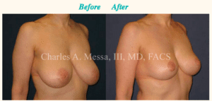 How Can Breast Reduction Surgery Change Your Life? - Featured Image