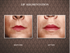 Before and After Lip Augmentation