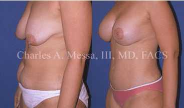 Tummy Tuck Recovery Guide - Featured Image