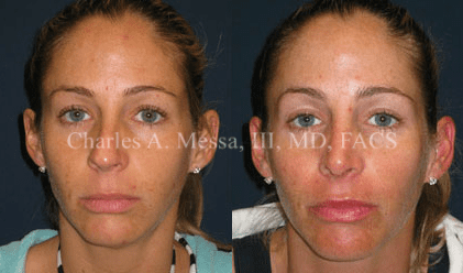 Achieving Your Best Nose: Rhinoplasty - Featured Image