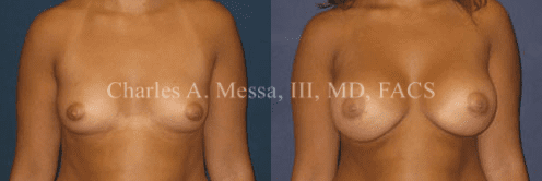 Am I Too Old for a Breast Augmentation?