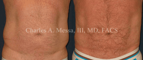 Male Liposuction Before and After Photos
