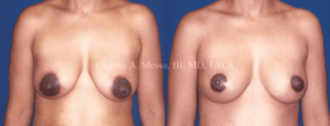 Before and After Breast Lift Surgery