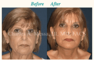 How to Get the Best Results With a Facelift - Featured Image