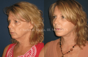 Why a Neck Lift is One of the Best Cosmetic Procedures - Featured Image