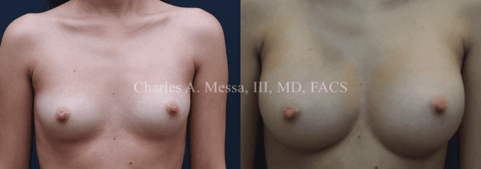 How to Get Your Ideal Breast Augmentation Results - Featured Image