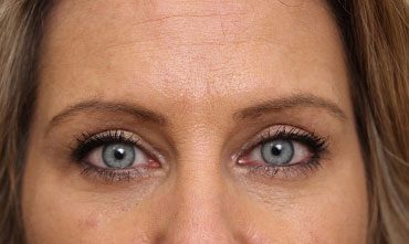 Eyelid Surgery in Weston, Florida After Patient 1
