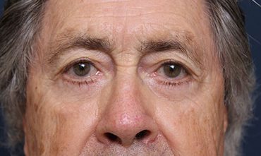 Eyelid Surgery in Weston, Florida After Patient 2