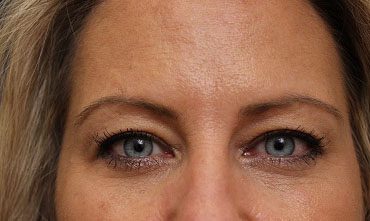 Eyelid Surgery in Weston, Florida Before Patient 1