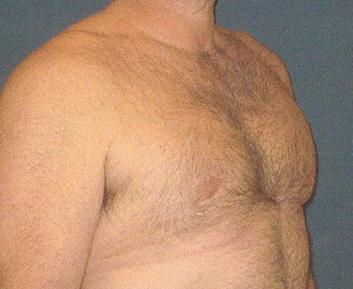Male Breast Reduction in Weston, Florida After Patient 2