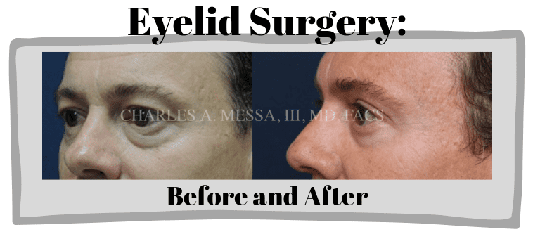 Improve Your Appearance With Eyelid Surgery - Featured Image