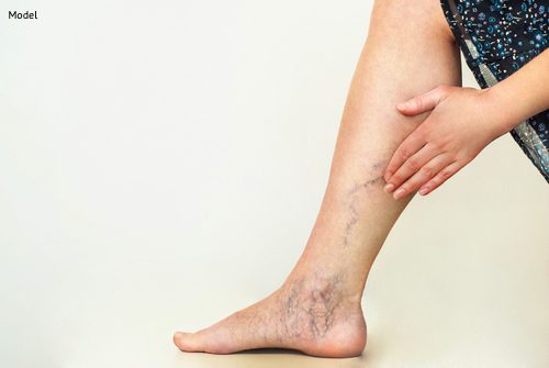 Eliminate Varicose Veins With Laser Skin Resurfacing - Featured Image