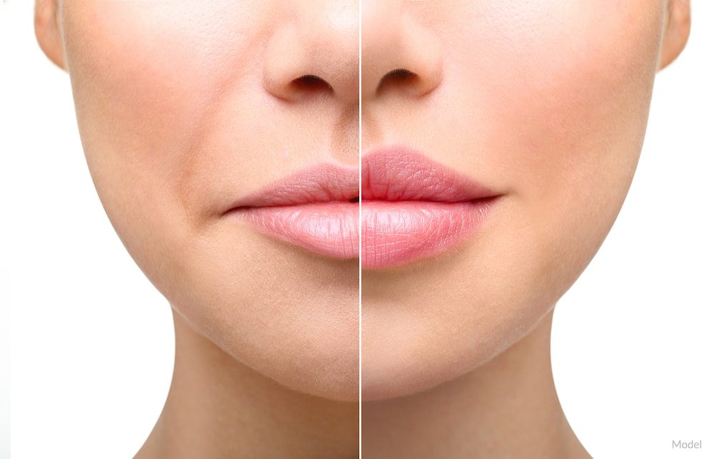 Image showing a model before and after her lip enhancement procedure.