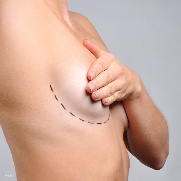 Incision Placement Featured Model