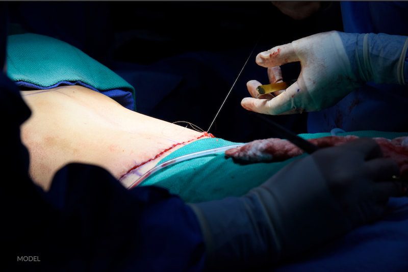 Woman on the operating table with her tummy tuck incision sewed up