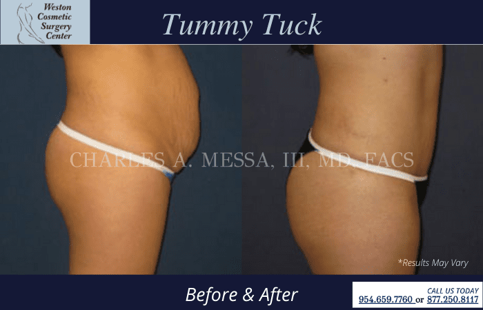 Before and after image showing the results of a tummy tuck performed in Weston, FL.