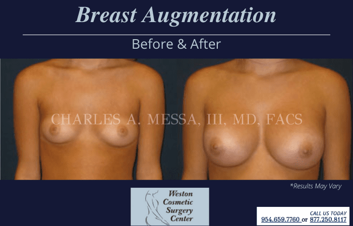 Before and after image showing the results of a breast augmentation performed in Weston, FL.