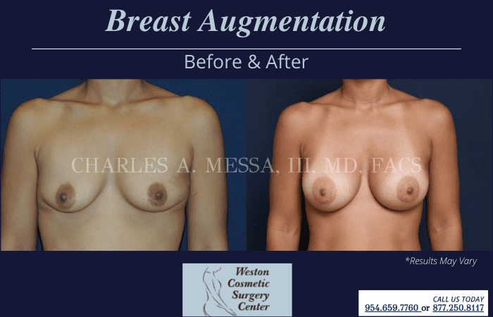 https://www.westoncosmeticsurgery.com/photo-gallery/breast-augmentation/