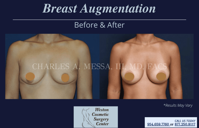 Before and after image showing the results of a breast augmentation performed in Weston, FL