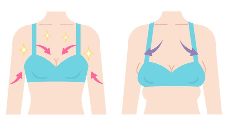 Illustration of breasts before and after weight loss.