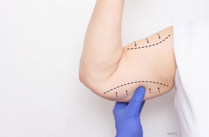 How Can I Avoid Scars After My Arm Lift? - Featured Image