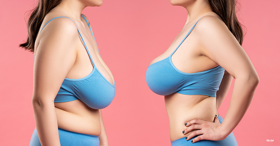 before and after breast augmentation and lift