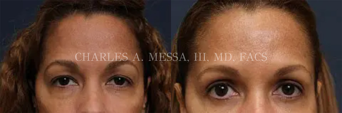 before and after pictures of an eyelid lift patient